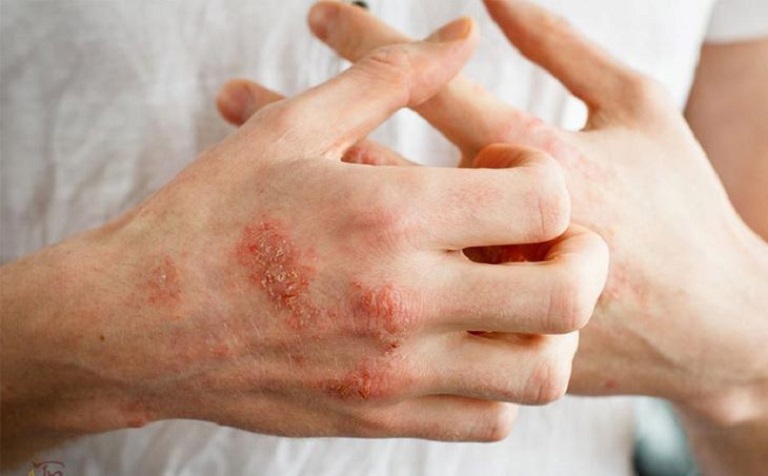 Mề đay mãn tính để lâu ngày có thể gây chàm hóa da