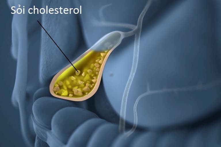Sỏi cholesterol là dạng phổ biến nhất của sỏi túi mật