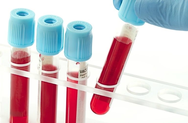 Tiến hành xét nghiệm kháng thể trong máu của bệnh nhân