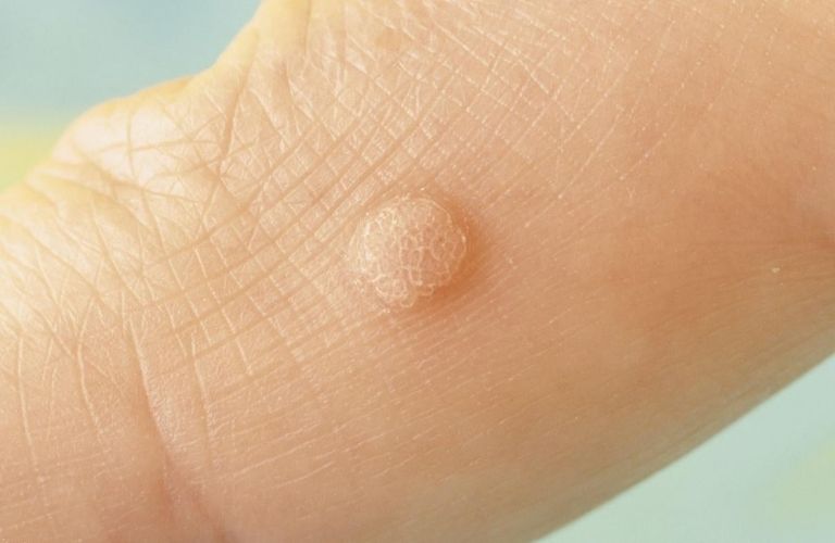 Bệnh hạt cơm không gây đau nhưng khiến vùng da rất mất thẩm mỹ