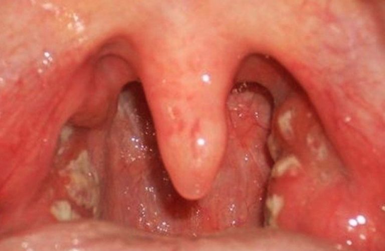 Các hạt với kích thước khác nhau xuất hiện trong cổ họng
