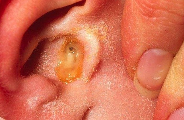 Viêm tai giữa là một biến chứng nguy hiểm dễ xảy ra ở trẻ nhỏ  