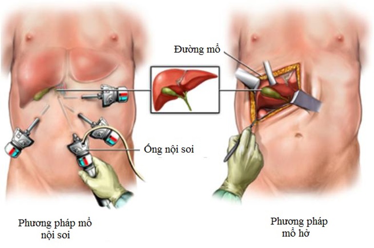 Tìm hiểu về phẫu thuật cắt túi mật nội soi