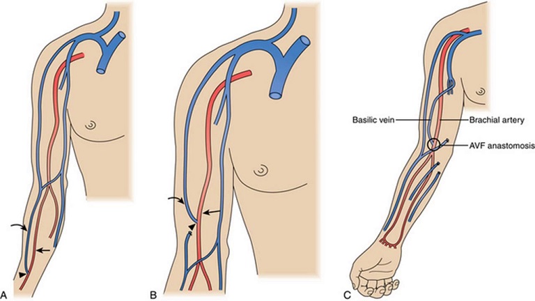 Bác sĩ có thể chỉ định phẫu thuật FAV kết nối động - tĩnh mạch