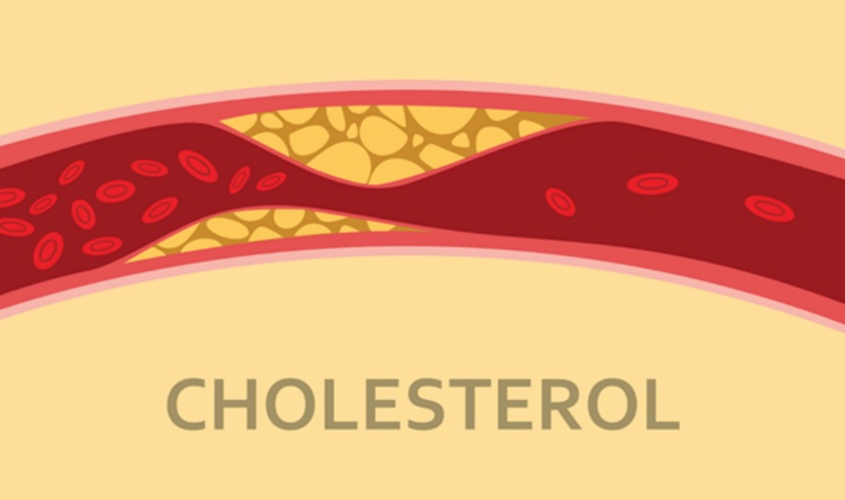 Cholesterol cao là bệnh lý gây nguy hiểm tới tính mạng