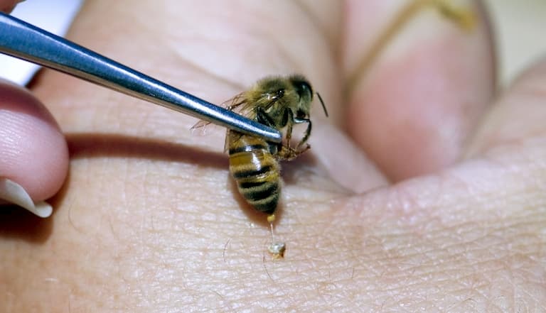 Chữa bệnh khớp bằng ong châm cần được thực hiện bởi chuyên gia