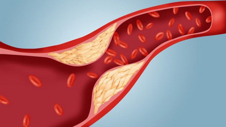 Giảm cholesterol là biện pháp cần thực hiện để phòng tránh các bệnh lý nguy hiểm 
