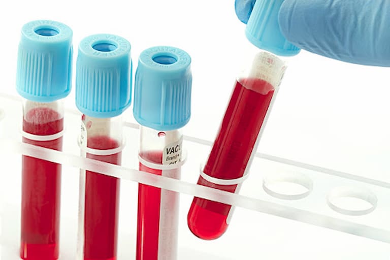 Xét nghiệm máu là một trong các biện pháp chẩn đoán phổ biến