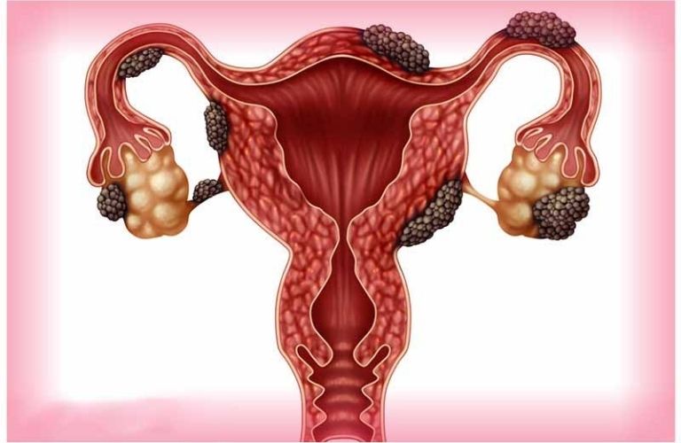 Lạc nội mạc tử cung có thể hình thành nên các khối u ở nhiều vị trí khác nhau ở vùng chậu
