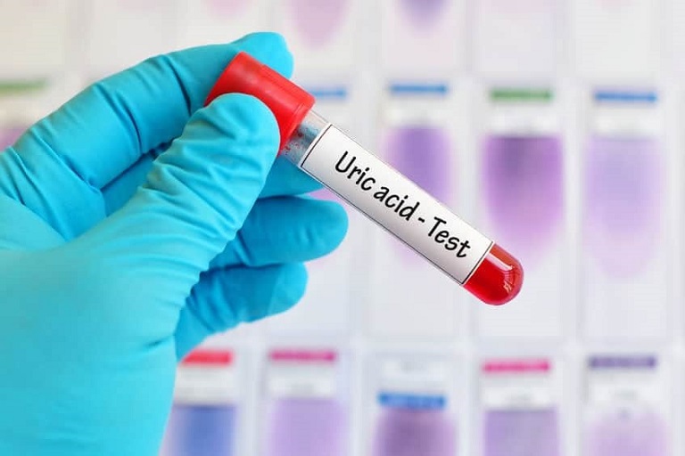 Xét nghiệm acid uric được thực hiện giúp chẩn đoán nhiều bệnh khác nhau