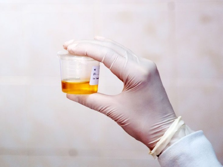Xét nghiệm creatinine trong nước tiểu là một kỹ thuật được thực hiện bên cạnh xét nghiệm creatinin máu