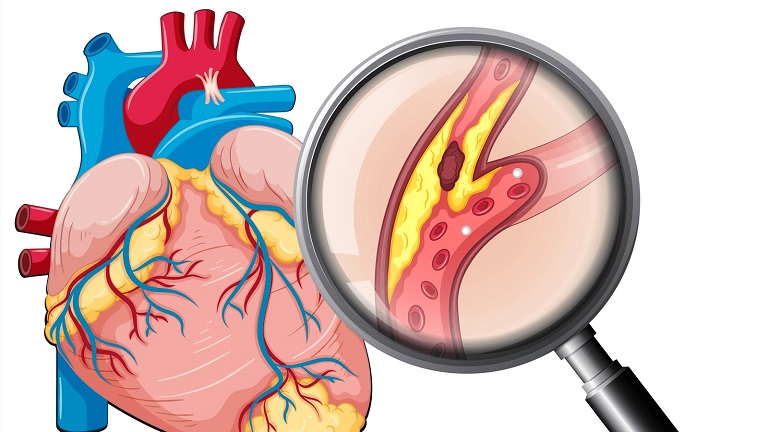 Xét nghiệm chỉ số triglycerid giúp phát hiện sớm các nguy cơ về bệnh tim mạch