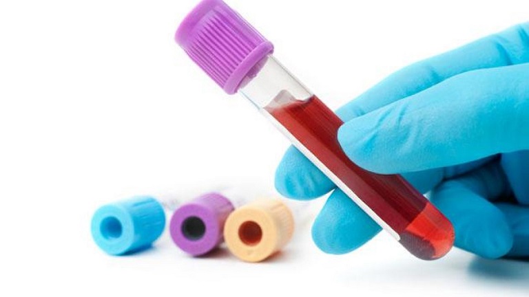 Xét nghiệm ure máu có ý nghĩa quan trọng với sức khỏe con người