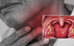 Viêm họng do virus: Dấu hiệu, chẩn đoán và cách điều trị