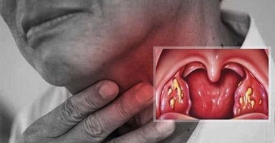 Viêm họng do virus: Dấu hiệu, chẩn đoán và cách điều trị