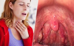 Viêm họng hạt là gì? Nguyên nhân, triệu chứng và phương pháp điều trị bệnh dứt điểm