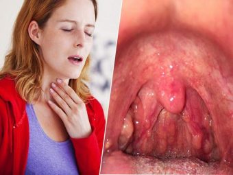 Viêm họng hạt là gì? Nguyên nhân, triệu chứng và phương pháp điều trị bệnh dứt điểm