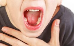 Viêm họng hạt ở lưỡi: Nguyên nhân và cách điều trị nhanh chóng