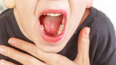 Viêm họng hạt ở lưỡi: Nguyên nhân và cách điều trị nhanh chóng