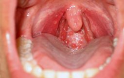 Viêm họng mạn tính quá phát: Dấu hiệu nhận biết bệnh và cách điều trị