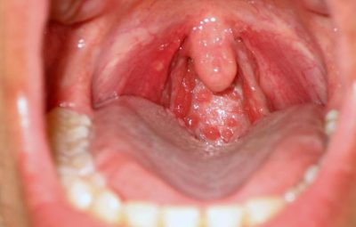 Viêm họng mạn tính quá phát: Dấu hiệu nhận biết bệnh và cách điều trị