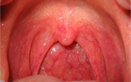 Viêm họng xung huyết: Dấu hiệu nguy hiểm và cách chữa trị triệt để
