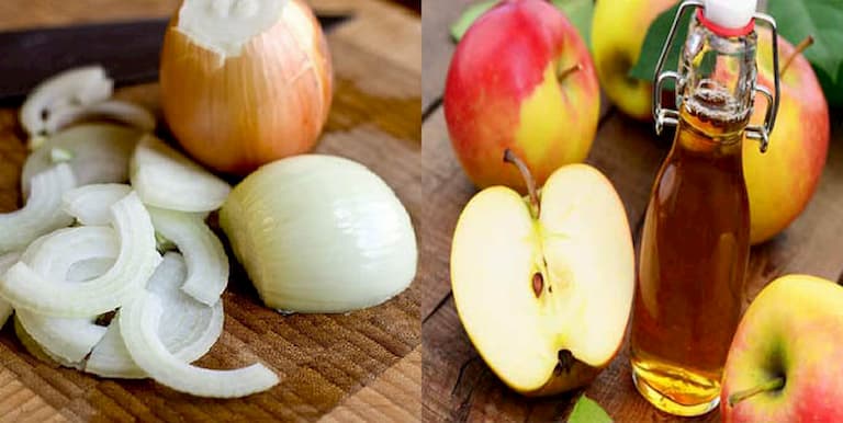 Hành tây và giấm táo giúp giảm chứng đau nhức đầu gối hiệu quả
