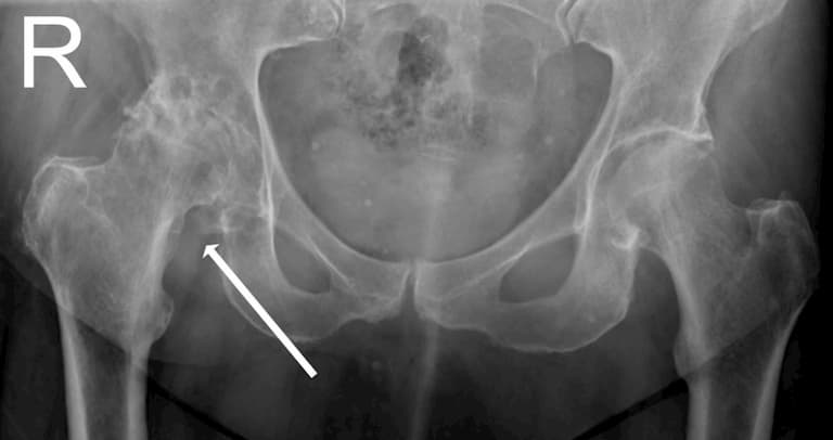 Việc chẩn đoán bằng các kiểm tra hình ảnh như X-quang thường được tiến hành
