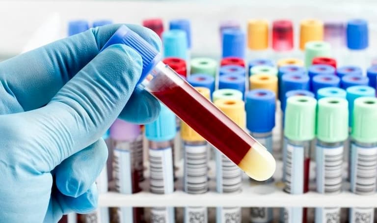 Xét nghiệm máu có thể được sử dụng trong chẩn đoán viêm da liên cầu