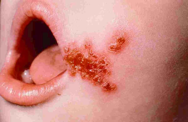 Bệnh đặc trưng bởi các mảng đỏ sần sùi trên da