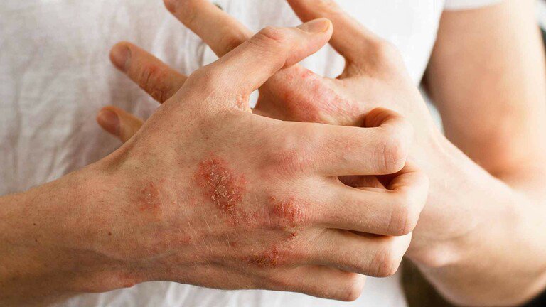 Vùng da bị tổn thương xuất hiệu các triệu chứng như nổi các nốt ban, bề mặt sưng đỏ, nổi mụn nước, ngứa ngáy,...
