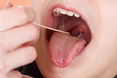Viêm họng hạt có lây không? Biện pháp phòng ngừa lây nhiễm hiệu quả