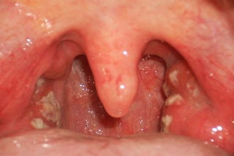 Mắc viêm họng hạt có nguy hiểm không?