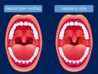 Dấu hiệu nhận biết amidan bình thường và amidan bị viêm