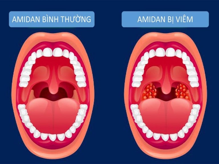Amidan được ví như tấm lá chắn bảo vệ hệ hô hấp