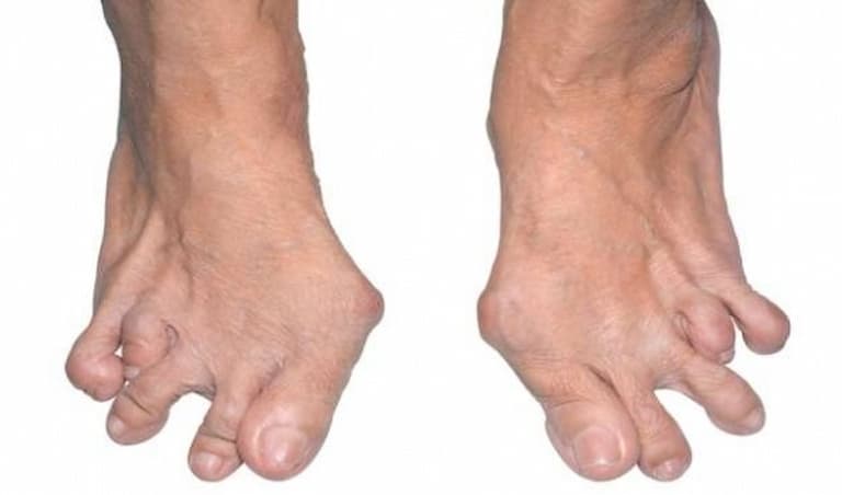 Nếu không điều trị sớm người bệnh có thể bị biến dạng khớp ngón chân