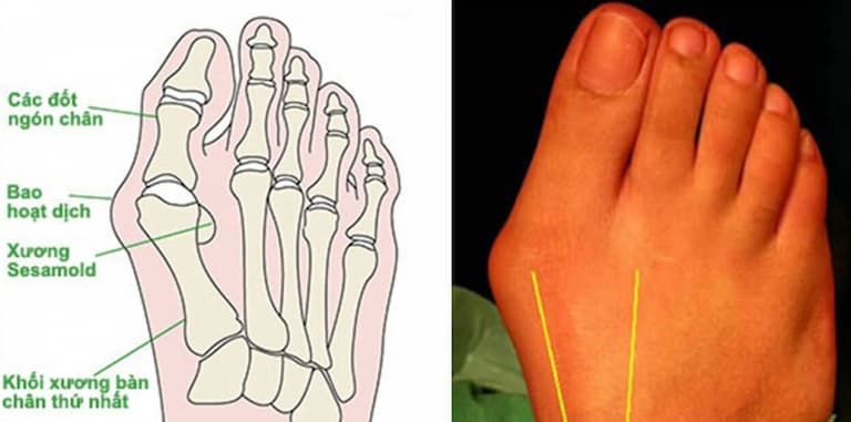 Tình trạng đau nhức khớp ngón chân có thể do viêm bao hoạt dịch gây ra