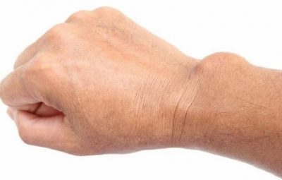 Viêm bao hoạt dịch khớp cổ tay: Hình ảnh, triệu chứng và cách điều trị