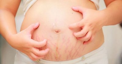 Viêm da cơ địa khi mang thai: Nguyên nhân, cách điều trị an toàn cho mẹ và bé