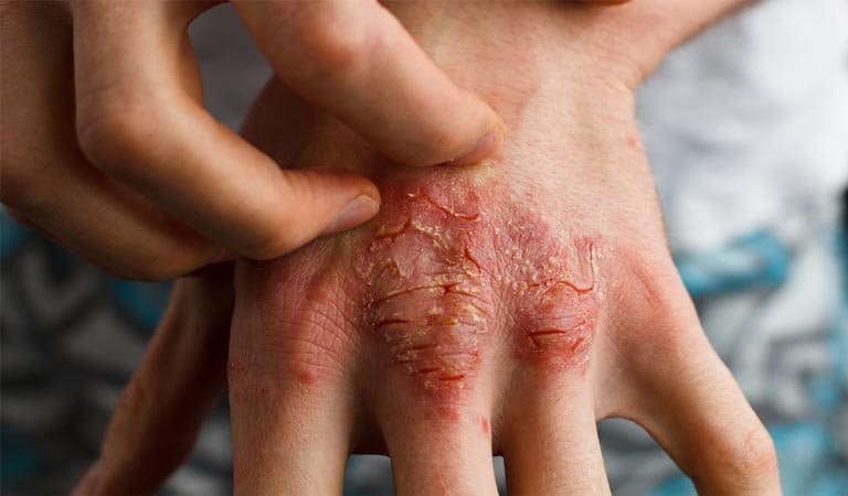 Nguyên nhân gây viêm da cơ địa ở tay chưa được xác định cụ thể nhưng có nhiều yếu tố bên ngoài tác động khiến bệnh bùng phát