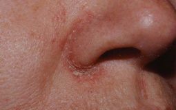 Viêm da dầu ở cánh mũi: Nguyên nhân, triệu chứng và cách chữa tận gốc an toàn
