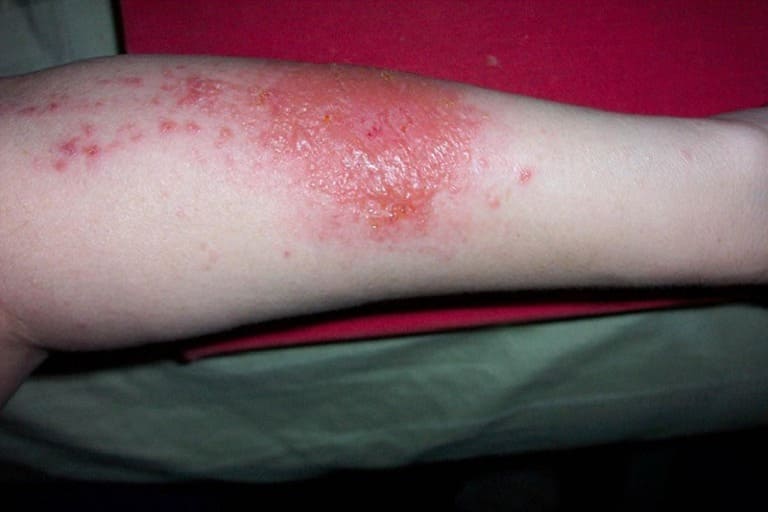 Khi bị bội nhiễm, diện tích da tổn thương rộng hơn kèm theo nguy cơ lên mủ