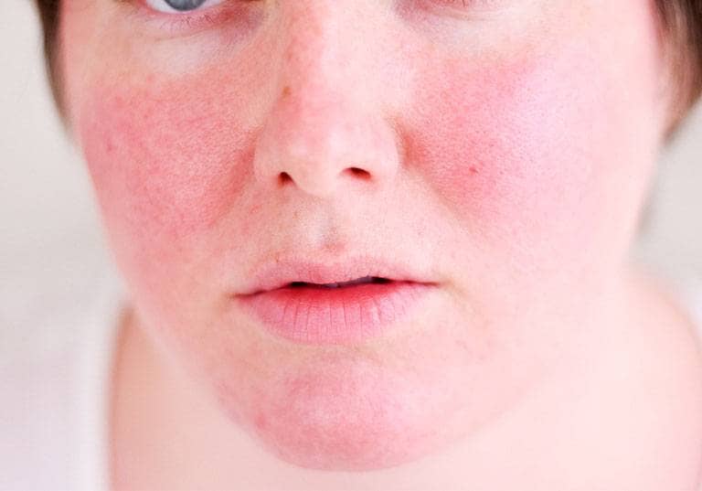 Tình trạng viêm da dị ứng ở mặt có nguy cơ tái phát lại nhiều lần trở thành bệnh mãn tính