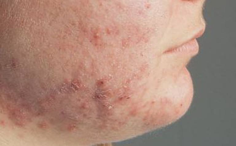 Dấu hiệu nhận biết viêm da dị ứng nổi bật là ban đỏ, mụn mọc bất thường trên mặt, bong tróc vảy