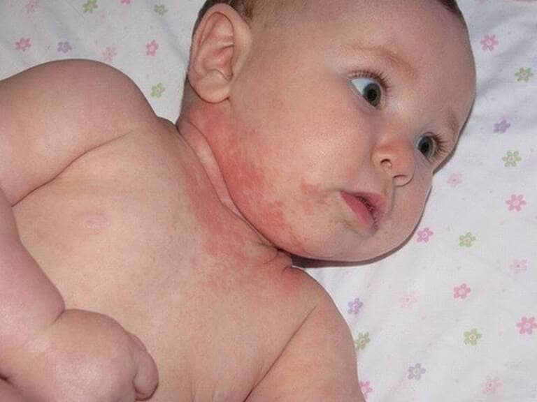 Bệnh viêm da dị ứng có thể xuất hiện ở trẻ sơ sinh và trẻ đã lớn