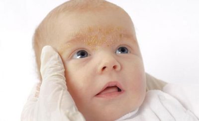 Viêm da dị ứng ở trẻ em: Nguyên nhân, dấu hiệu và cách khắc phục an toàn