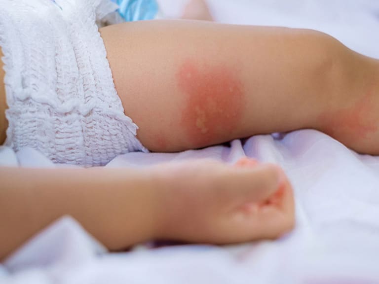 Bệnh viêm da dị ứng ở trẻ em có thể dẫn đến nhiều biến chứng nguy hiểm