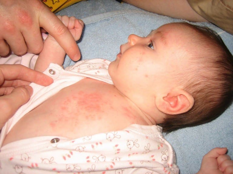 Bệnh viêm da mủ thường xuất hiện khi trẻ 2 - 12 tháng tuổi
