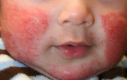 Viêm da ở trẻ sơ sinh: Dấu hiệu nhận biết và cách điều trị triệt để