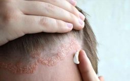 Viêm da tiết bã da đầu là bệnh gì? Tìm hiểu nguyên nhân, triệu chứng và cách chữa trị